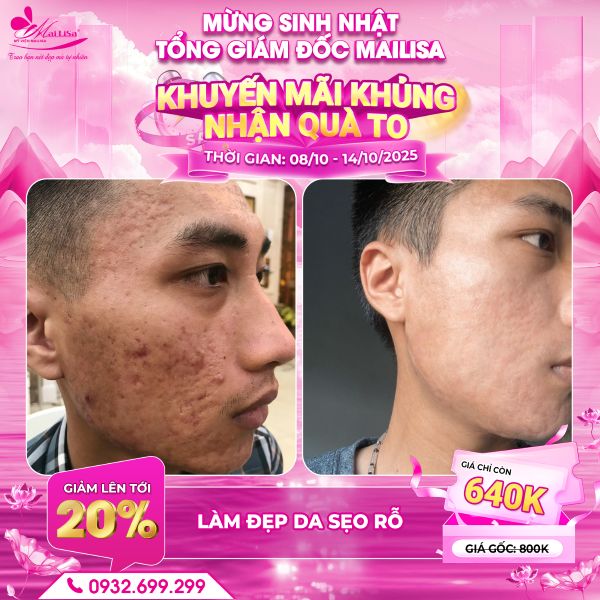 làm đẹp da sẹo rỗ