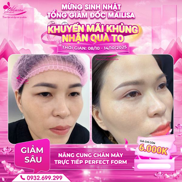 nâng cung chân mày trực tiếp perfect form