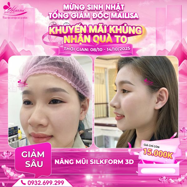 nâng mũi silkform 3d
