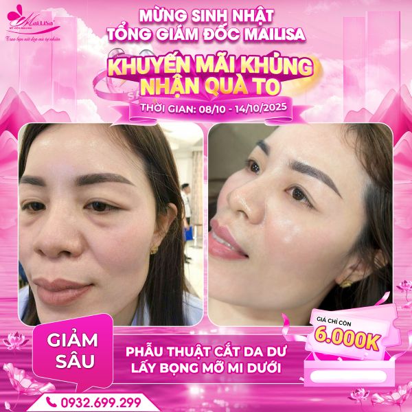 phẫu thuật cắt da dư lấy bọng mỡ mi dưới