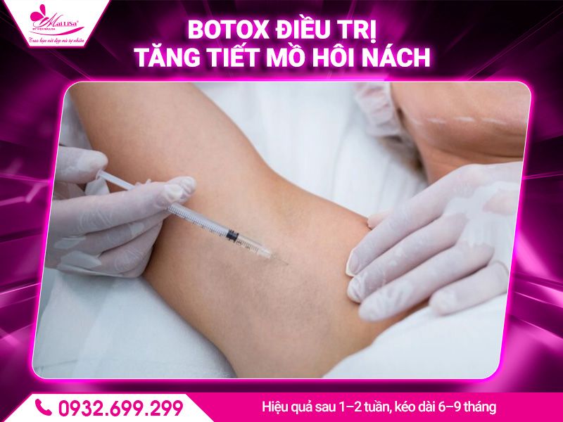 botox-dieu-tri-tang-tiet-mo-hoi-nach