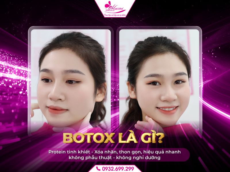 botox-la-gi