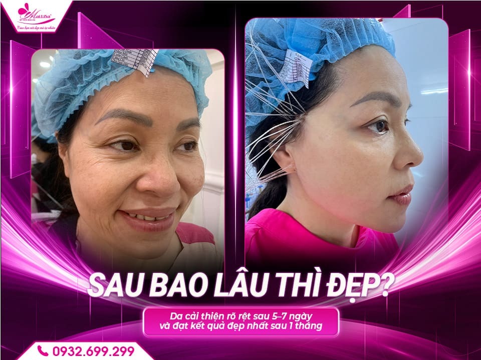 cang-chi-da-mat-bao-lau-thi-dep