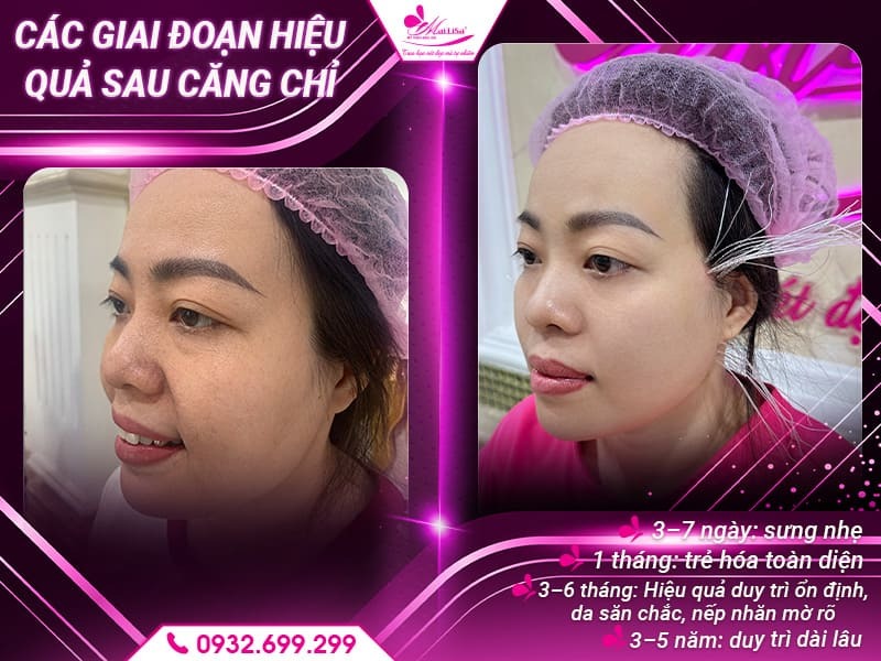 cang-chi-da-mat-bao-lau-thi-dep