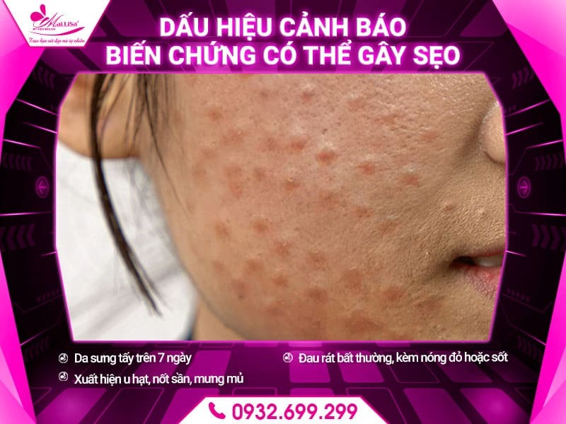 cay-meso-co-de-lai-seo-khong
