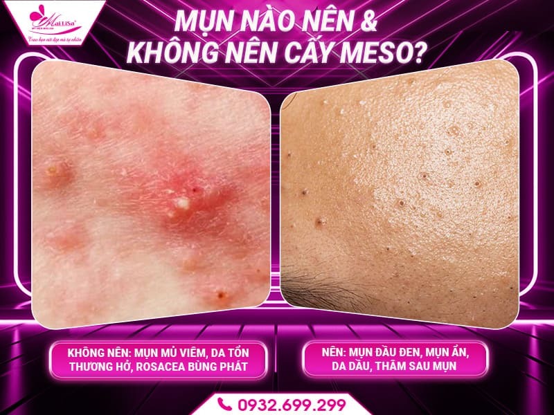 cay-meso-tri-mun-duoc-khong