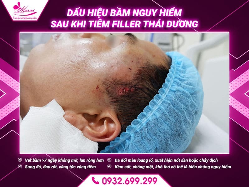 co-bi-bam-sau-khi-tiem-filler-thai-duong-khong