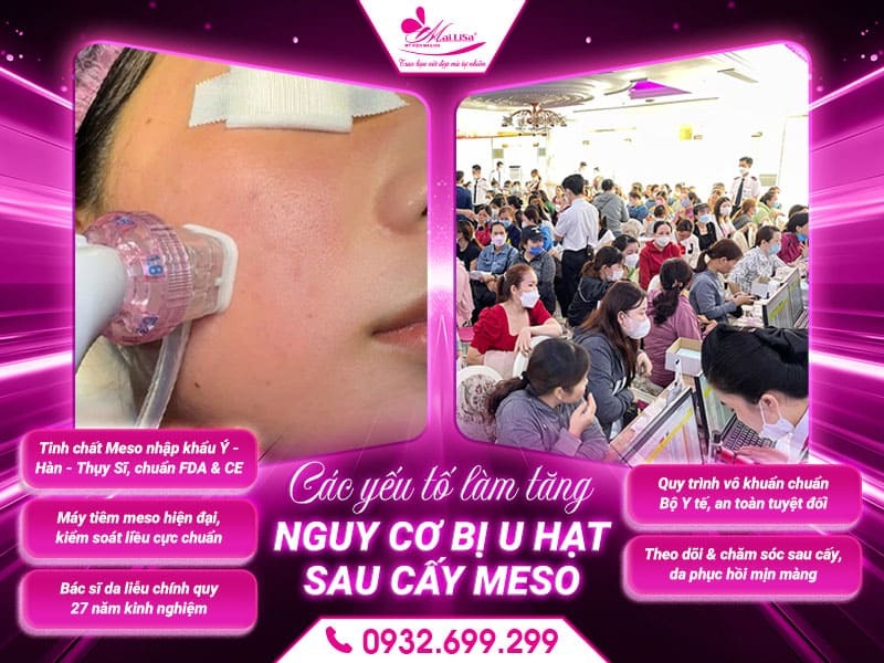 dau-hieu-u-hat-sau-tiem-meso