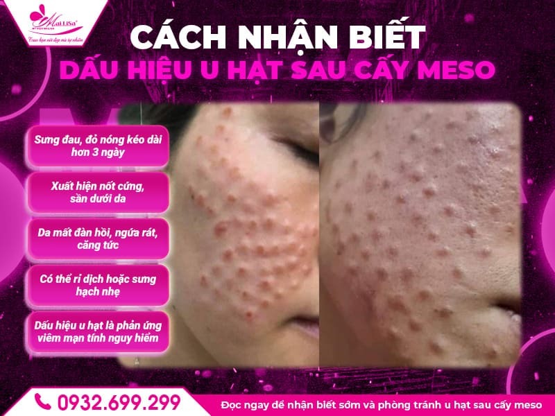 dau-hieu-u-hat-sau-cay-meso