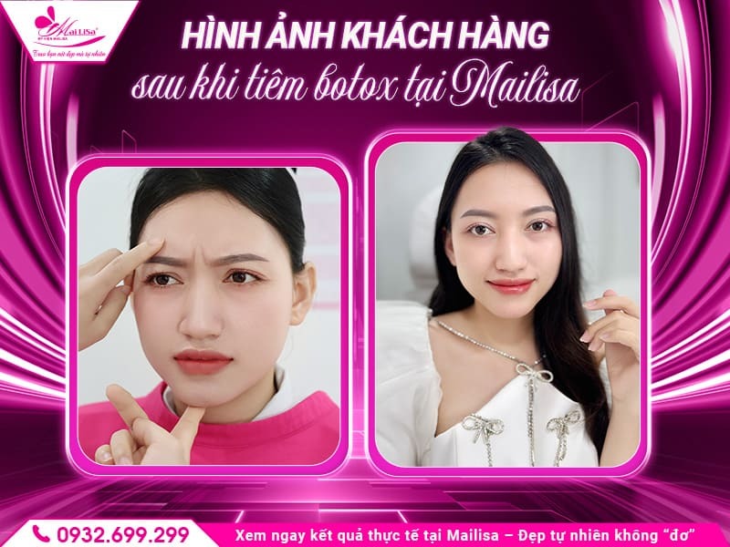 gia-tiem-botox-xoa-nhan-may-tai-mailisa