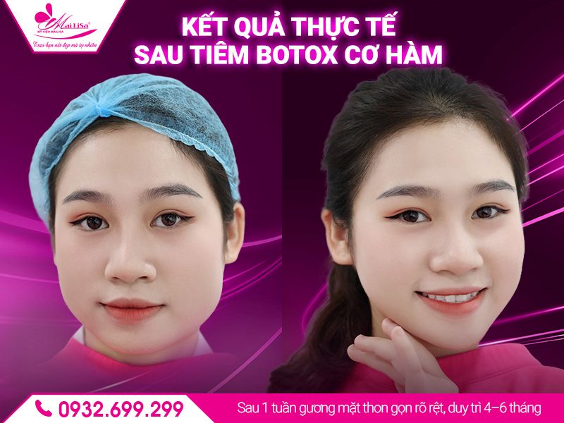 ket-qua-thuc-te-sau-tiem-botox-co-ham