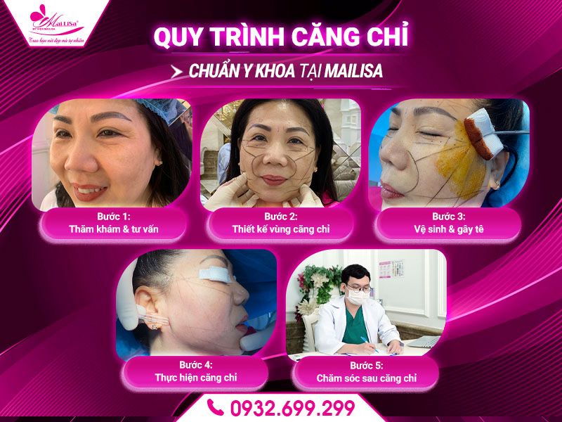 quy-trinh-cang-chi-chuan-y-khoa-tai-mailisa