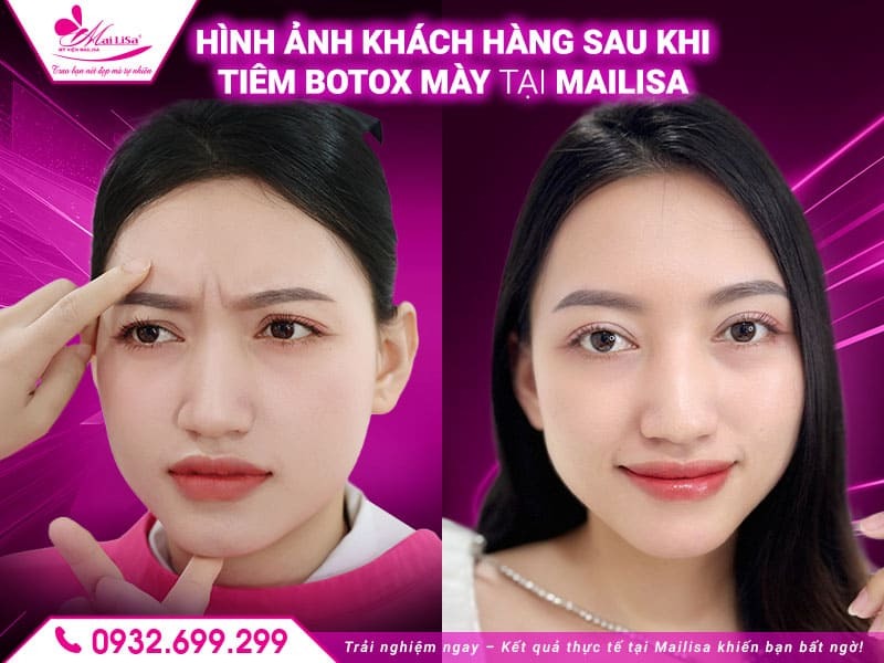 sau-tiem-botox-vung-may-co-can-nghi-duong-khong