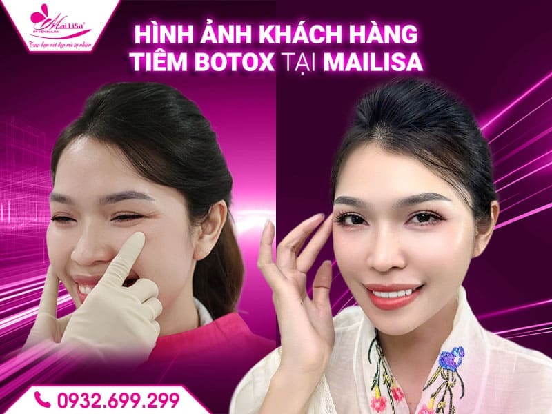 sung-do-sau-tiem-botox-mat-co-binh-thuong-khong