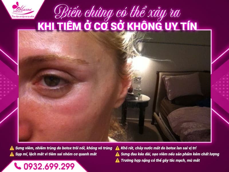 sung-do-sau-tiem-botox-mat-co-binh-thuong-khong