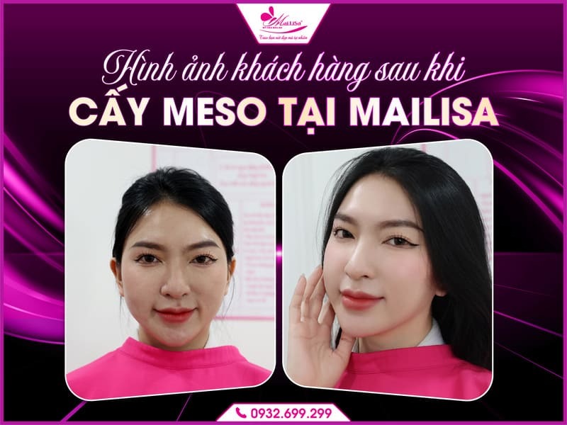 tiem-bap-mailisa-vinh
