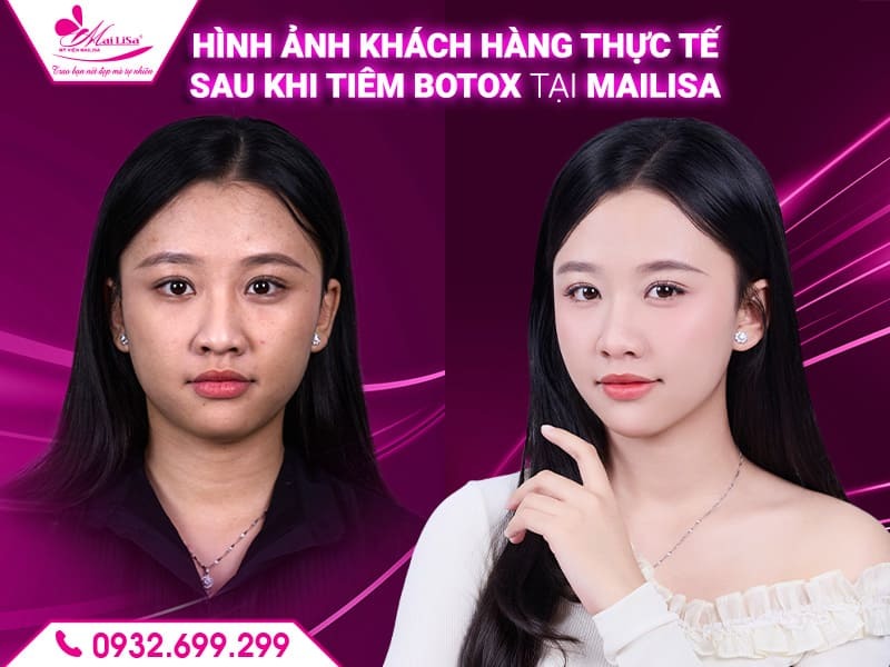 tiem-botox-mailisa-nha-trang