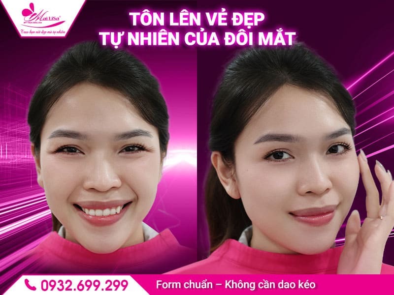 https://mailisa.com tiem-botox-mailisa-vinh