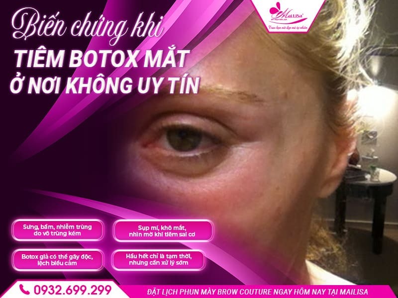 tiem-botox-mat-co-bien-chung-khong