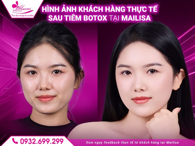 tiem-botox-vung-may-tai-mailisa-co-an-toan-khong