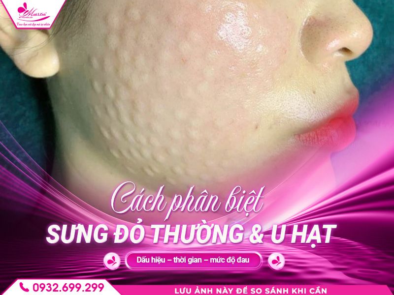 https://mailisa.com cach-phan-biet-sung-do-thuong-u-hat
