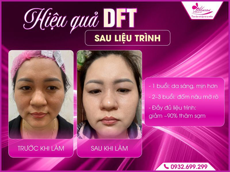 hieu-qua-dft-sau-lieu-trinh