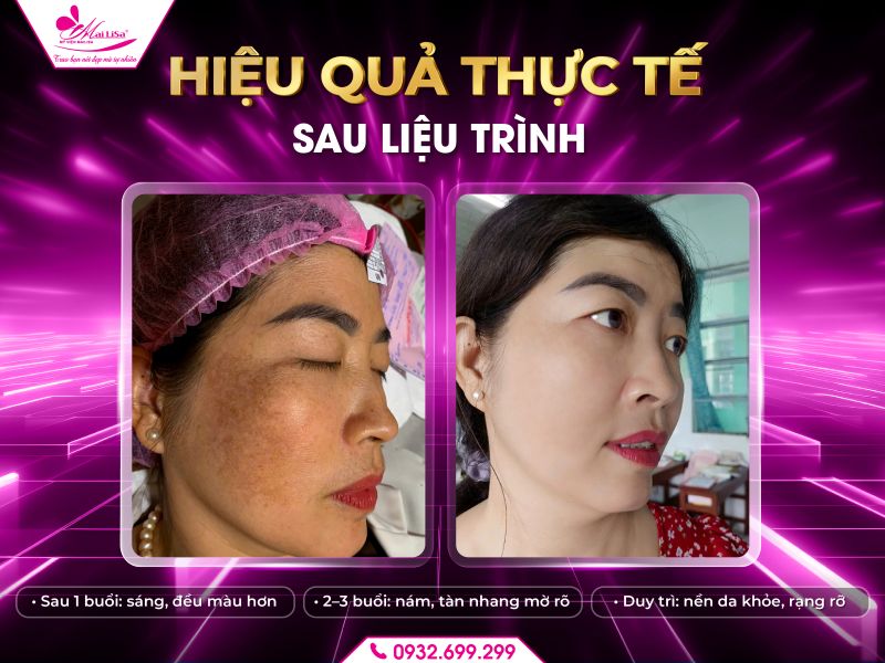 https://mailisa.com hieu-qua-thuc-te-sau-lieu-trinh