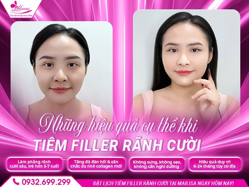 tiem-filler-ranh-cuoi-co-hieu-qua-khong